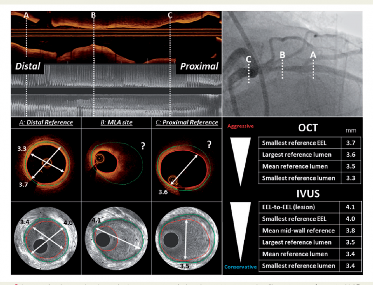 Intracoronary Imaging Heart Diagnostics Dr G Sengottuvelu